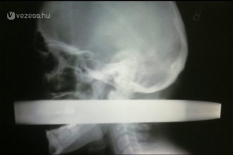 Átszúrta a cső a fejét, de túlélte - videó