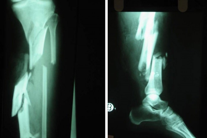 Mi történik az emberi testtel autóbalesetben? 8