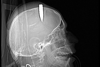 Fejbe szúrta a buszsofőrt