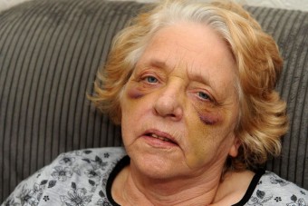 Másfél órát várt a mentőre az elgázolt nagymama