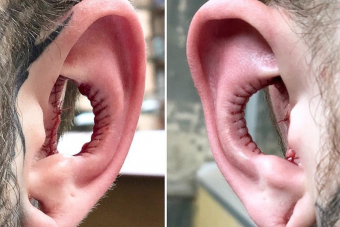 Kivágatta a füle közepét egy extrém testmódosító srác