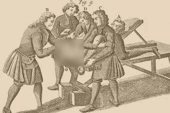 Régen pokoli műtéttel kezelték, ma fájdalommentesen gyógyítható ez a férfibaj