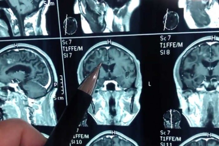 30 évig fájt a feje a férfinak, mire rájöttek az orvosok a problémára