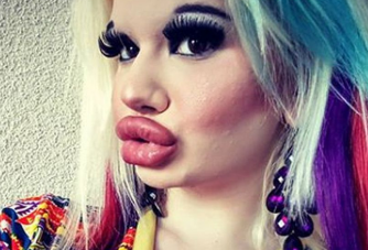 Óriási ajkai lettek a nőnek aki 17 injekciót vállalt be