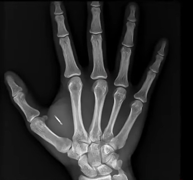 Bőre alá ültette a kocsikulcsot egy férfi 1 | Vezess Bőre alá ültette a kocsikulcsot egy férfi 1