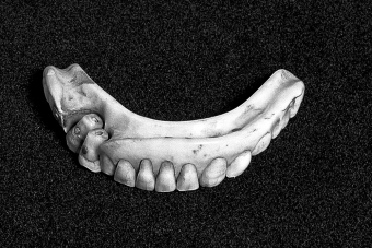 Halott katonák fogaiból készültek a legdrágább fogpótlások 200 éve